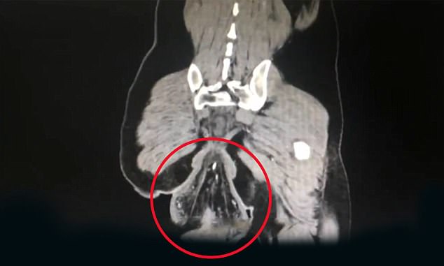 Rayos X del bulto que tenía el paciente